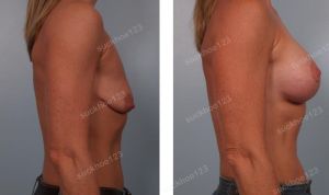 Treo ngực sa trễ kết hợp đặt túi Mentor size 275 -300 cc, nữ 36 tuổi - ca 16