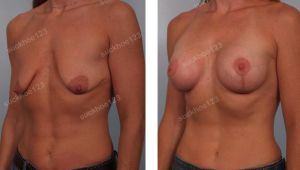 Treo ngực sa trễ kết hợp đặt túi Mentor size 275 -300 cc, nữ 36 tuổi - ca 16