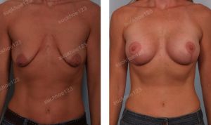 Treo ngực sa trễ kết hợp đặt túi Mentor size 275 -300 cc, nữ 36 tuổi - ca 16