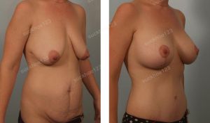 Combo treo sa trễ kết hợp đặt túi độn & tạo hình thành bụng, nữ 32 tuổi - ca 17