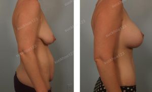 Combo treo sa trễ kết hợp đặt túi độn & tạo hình thành bụng, nữ 32 tuổi - ca 17