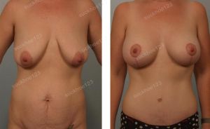 Combo treo sa trễ kết hợp đặt túi độn & tạo hình thành bụng, nữ 32 tuổi - ca 17