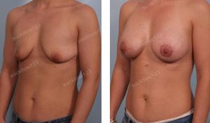 Treo sa trễ đường quầng kết hợp đặt túi nước muối Mentor, nữ 33 tuổi - ca 19