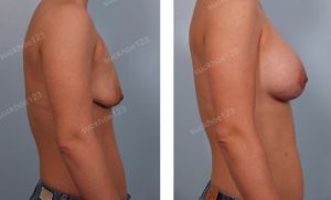 Treo sa trễ đường quầng kết hợp đặt túi nước muối Mentor, nữ 33 tuổi - ca 19