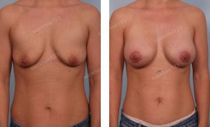 Treo sa trễ đường quầng kết hợp đặt túi nước muối Mentor, nữ 33 tuổi - ca 19