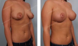 Treo ngực sa trễ kết hợp đặt túi Mentor 300 cc, nữ 27 tuổi - ca 2