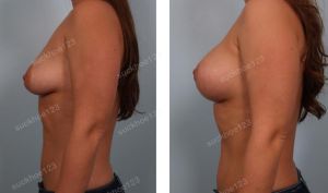 Treo ngực sa trễ kết hợp đặt túi Mentor 300 cc, nữ 27 tuổi - ca 2