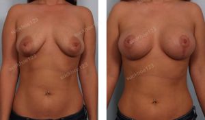 Treo ngực sa trễ kết hợp đặt túi Mentor 300 cc, nữ 27 tuổi - ca 2