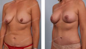 Combo treo sa trễ kết hợp đặt túi Mentor & tạo hình thành bụng, nữ 34 tuổi - ca 20