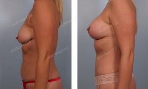 Combo treo sa trễ kết hợp đặt túi Mentor & tạo hình thành bụng, nữ 34 tuổi - ca 20