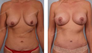 Combo treo sa trễ kết hợp đặt túi Mentor & tạo hình thành bụng, nữ 34 tuổi - ca 20