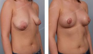 Treo ngực sa trễ kết hợp đặt túi Mentor size 375 -225 cc ở bệnh nhân nữ 25 tuổi ngực chảy xệ và lêch nặng - ca 22