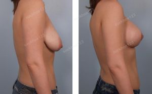 Treo ngực sa trễ kết hợp đặt túi Mentor size 375 -225 cc ở bệnh nhân nữ 25 tuổi ngực chảy xệ và lêch nặng - ca 22