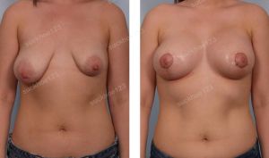 Treo ngực sa trễ kết hợp đặt túi Mentor size 375 -225 cc ở bệnh nhân nữ 25 tuổi ngực chảy xệ và lêch nặng - ca 22