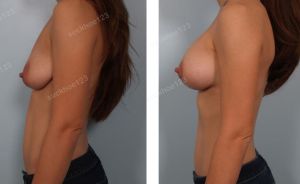 Treo ngực sa trễ kết hợp đặt túi Mentor size 255 cc, nữ 36 tuổi - ca 23