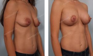 Treo ngực sa trễ kết hợp đặt túi Mentor size 255 cc, nữ 36 tuổi - ca 23