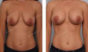 Treo ngực sa trễ kết hợp đặt túi Mentor size 255 cc, nữ 36 tuổi - ca 23