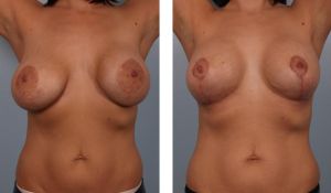 Treo sa trễ kết hợp thay túi độn, nữ 35 tuổi vú chảy xệ, quầng vú giãn rộng - ca 24