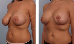 Treo sa trễ kết hợp thay túi độn, nữ 35 tuổi vú chảy xệ, quầng vú giãn rộng - ca 24