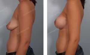 Treo ngực sa trễ đường quầng kết hợp đặt túi Mentor size 325 cc, nữ 37 tuổi - ca 27