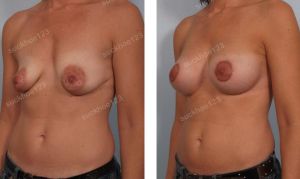 Treo ngực sa trễ đường quầng kết hợp đặt túi Mentor size 325 cc, nữ 37 tuổi - ca 27