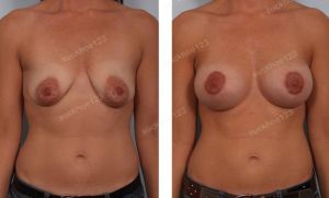 Treo ngực sa trễ đường quầng kết hợp đặt túi Mentor size 325 cc, nữ 37 tuổi - ca 27