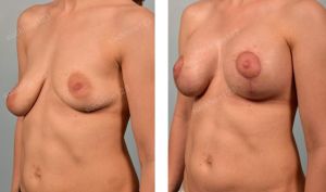 Treo sa trễ kết hợp đặt túi Sientra size 455 - 415 cc, nữ 30 tuổi ngực lệch nặng - ca 28