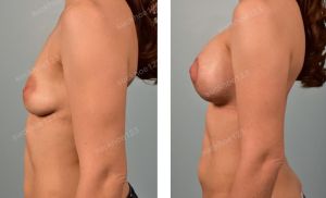 Treo sa trễ kết hợp đặt túi Sientra size 455 - 415 cc, nữ 30 tuổi ngực lệch nặng - ca 28