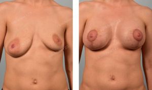 Treo sa trễ kết hợp đặt túi Sientra size 455 - 415 cc, nữ 30 tuổi ngực lệch nặng - ca 28