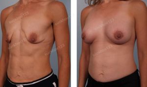 Treo sa trễ đường quầng kết hợp đặt túi Mentor size 325 cc - nữ huấn luận viên gym 30 tuổi- ca 29