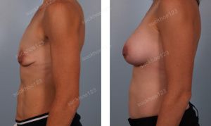 Treo sa trễ đường quầng kết hợp đặt túi Mentor size 325 cc - nữ huấn luận viên gym 30 tuổi- ca 29