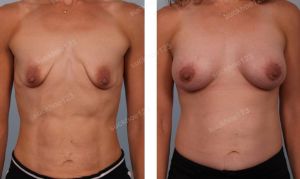 Treo sa trễ đường quầng kết hợp đặt túi Mentor size 325 cc - nữ huấn luận viên gym 30 tuổi- ca 29