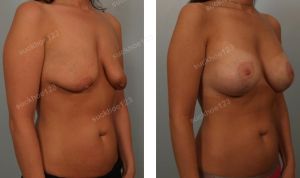 Treo sa trễ kết hợp đặt túi Sientra 350 cc, nữ 39 tuổi - ca 3