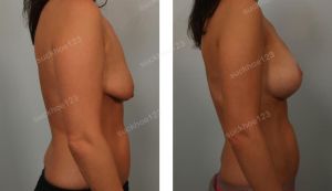 Treo sa trễ kết hợp đặt túi Sientra 350 cc, nữ 39 tuổi - ca 3