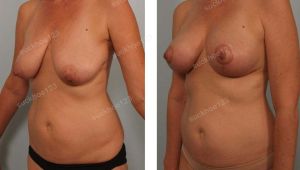 Treo ngực sa trễ kết hợp tiêm mỡ làm đầy cực trên vú, nữ 50 tuổi - ca 32