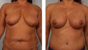 Treo ngực sa trễ kết hợp tiêm mỡ vào cực trên ngực, nữ 39 tuổi - ca 33