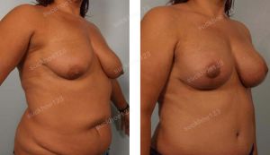 Treo ngực sa trễ kết hợp tiêm mỡ vào cực trên ngực, nữ 39 tuổi - ca 33