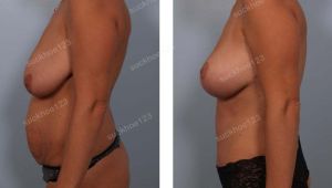 Combo treo sa trễ không đặt túi & tạo hình thành bụng và hút mỡ, nữ 34 tuổi - ca 36
