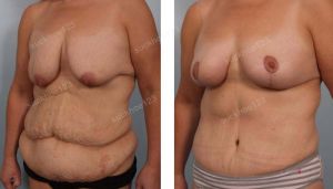 Combo treo sa trễ không đặt túi & tạo hình thành bụng & hút mỡ, nữ 40 tuổi sau giảm cân - ca 37