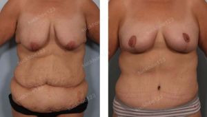 Combo treo sa trễ không đặt túi & tạo hình thành bụng & hút mỡ, nữ 40 tuổi sau giảm cân - ca 37