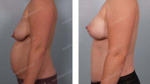 Combo treo sa trễ không đặt túi & tạo hình bụng và hút mỡ hông, nữ 38 tuổi - ca 38