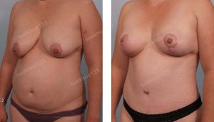 Combo treo sa trễ không đặt túi & tạo hình bụng và hút mỡ hông, nữ 38 tuổi - ca 38