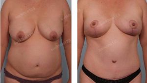 Combo treo sa trễ không đặt túi & tạo hình bụng và hút mỡ hông, nữ 38 tuổi - ca 38