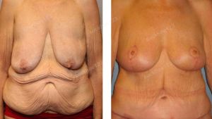 Combo treo ngực sa trễ không đặt túi & tạo hình thành bụng, nữ 60 tuổi nhiều da chùng sau giảm cân - ca 39