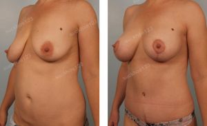 Treo ngực sa trễ kết hợp đặt túi Natrelle size 345 - 405 cc, nữ 38 tuổi - ca 4