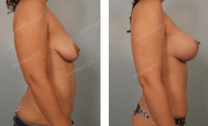 Treo ngực sa trễ kết hợp đặt túi Natrelle size 345 - 405 cc, nữ 38 tuổi - ca 4