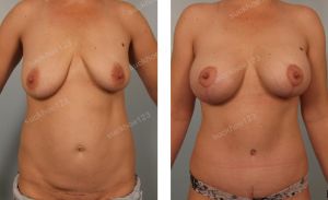 Treo ngực sa trễ kết hợp đặt túi Natrelle size 345 - 405 cc, nữ 38 tuổi - ca 4
