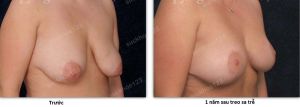 Treo ngực sa trễ không đặt túi, nữ 28 tuổi - ca 41