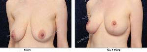 Treo ngực sa trễ không đặt túi, nữ 31 tuổi - ca 43