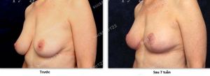 Treo ngực sa trễ không đặt túi, nữ 53 tuổi - ca 44